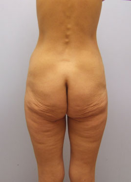 Tummy Tuck Before & After Image