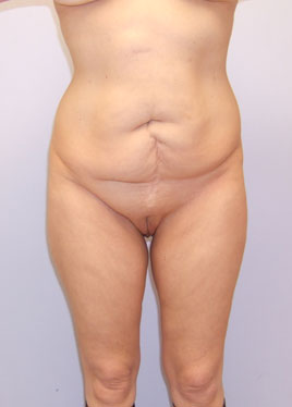 Tummy Tuck Before & After Image