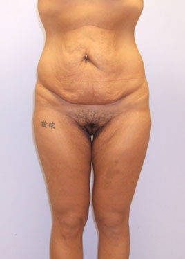 Tummy Tuck Before & After Image