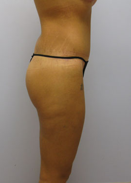 Tummy Tuck Before & After Image