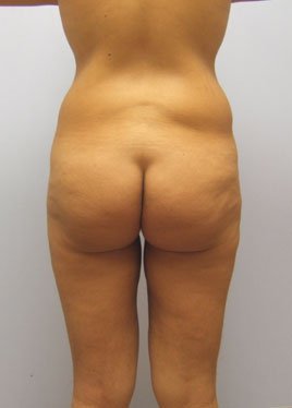 Tummy Tuck Before & After Image