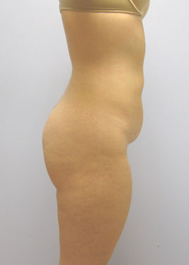 Tummy Tuck Before & After Image