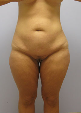 Tummy Tuck Before & After Image