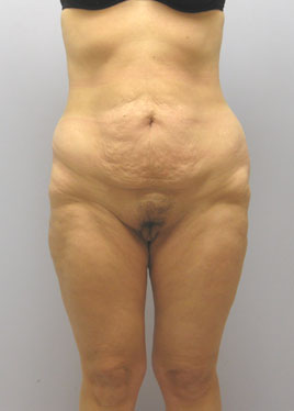 Tummy Tuck Before & After Image