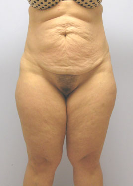 Tummy Tuck Before & After Image