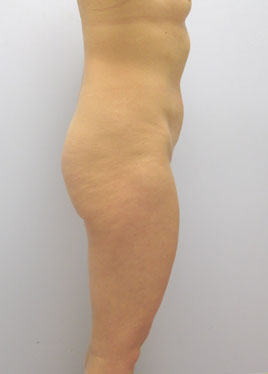 Tummy Tuck Before & After Image