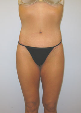 Tummy Tuck Before & After Image