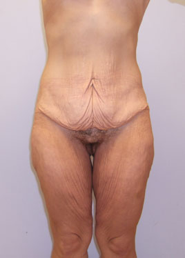 Tummy Tuck Before & After Image