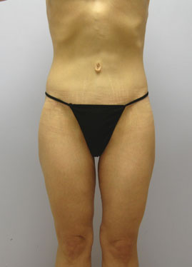 Tummy Tuck Before & After Image