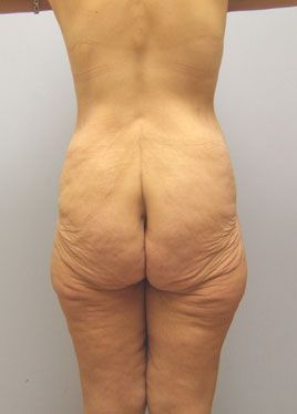 Tummy Tuck Before & After Image