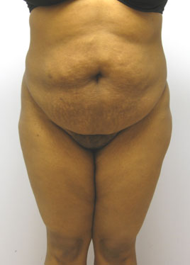 Tummy Tuck Before & After Image