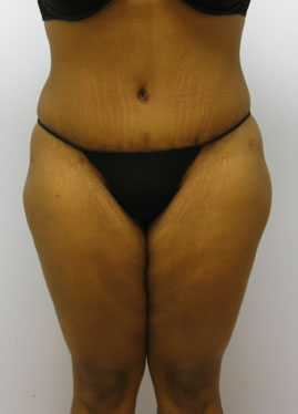 Tummy Tuck Before & After Image