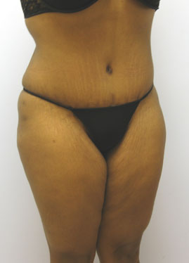 Tummy Tuck Before & After Image