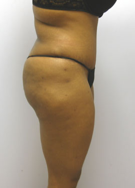 Tummy Tuck Before & After Image