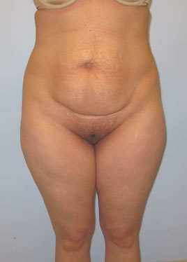 Tummy Tuck Before & After Image