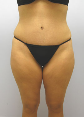 Tummy Tuck Before & After Image