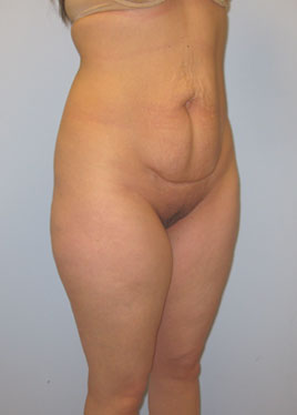 Tummy Tuck Before & After Image