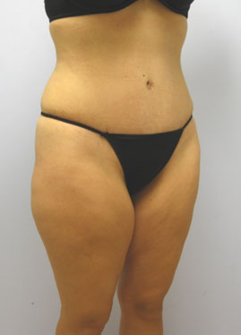 Tummy Tuck Before & After Image