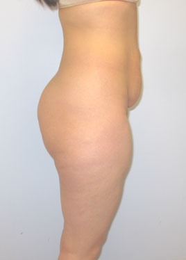 Tummy Tuck Before & After Image