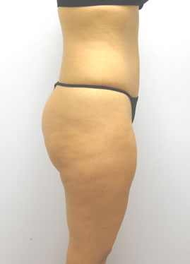 Tummy Tuck Before & After Image