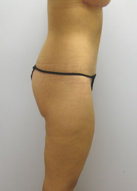 Tummy Tuck Before & After Image