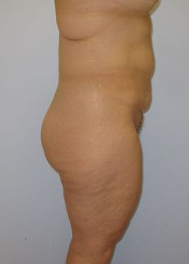 Tummy Tuck Before & After Image