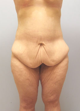 Tummy Tuck Before & After Image