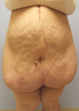 Tummy Tuck Before & After Image