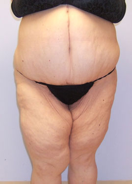 Tummy Tuck Before & After Image