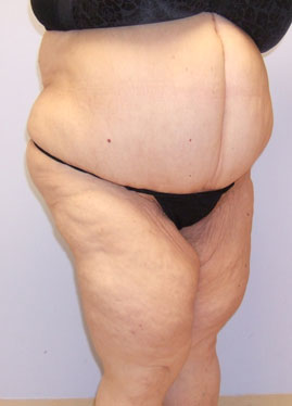 Tummy Tuck Before & After Image