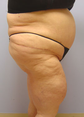 Tummy Tuck Before & After Image