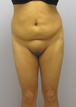 Tummy Tuck Before & After Image