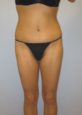 Tummy Tuck Before & After Image