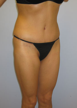 Tummy Tuck Before & After Image