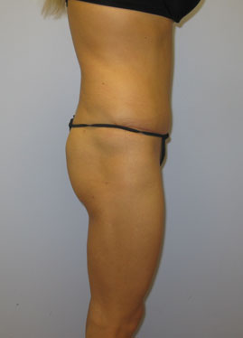 Tummy Tuck Before & After Image