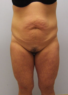 Tummy Tuck Before & After Image