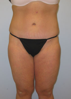 Tummy Tuck Before & After Image