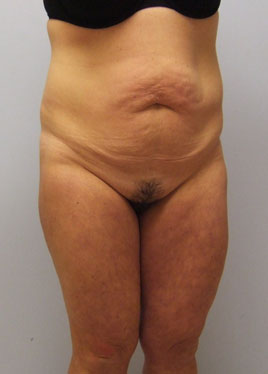 Tummy Tuck Before & After Image