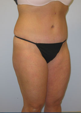 Tummy Tuck Before & After Image