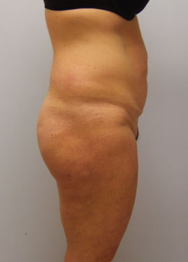 Tummy Tuck Before & After Image