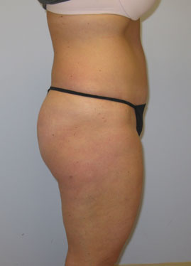 Tummy Tuck Before & After Image