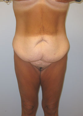 Tummy Tuck Before & After Image