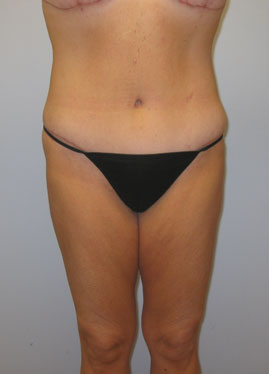 Tummy Tuck Before & After Image