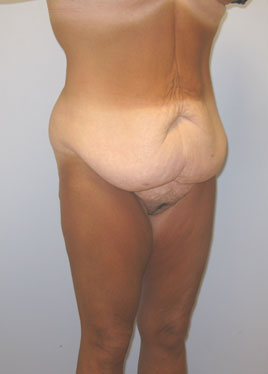 Tummy Tuck Before & After Image