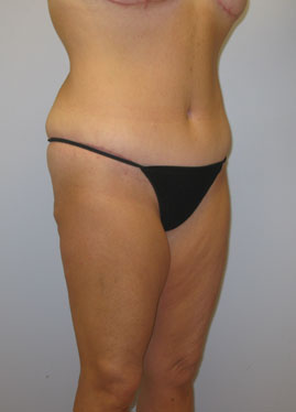 Tummy Tuck Before & After Image