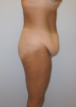 Tummy Tuck Before & After Image