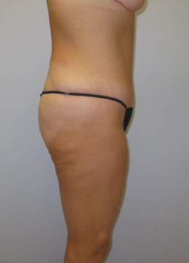 Tummy Tuck Before & After Image