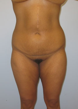 Tummy Tuck Before & After Image