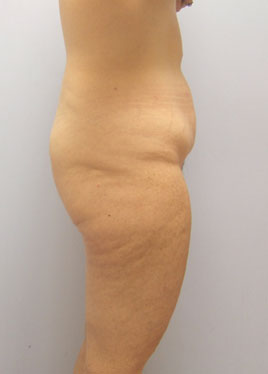 Tummy Tuck Before & After Image