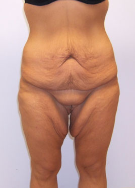 Tummy Tuck Before & After Image